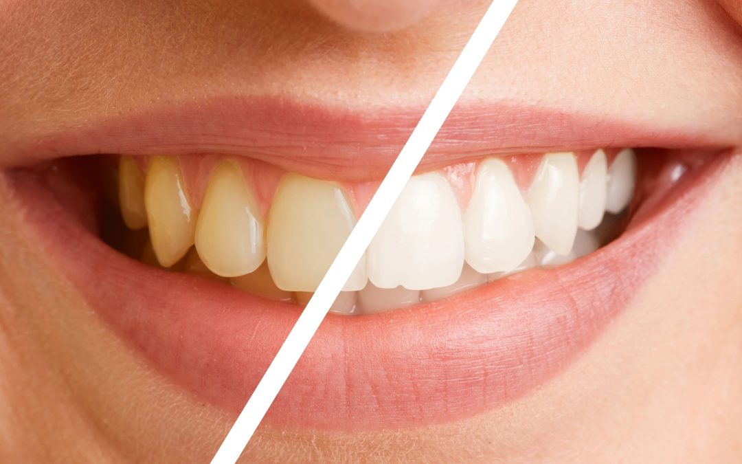 Guide to Tartar: Prevention, Treatment, and More