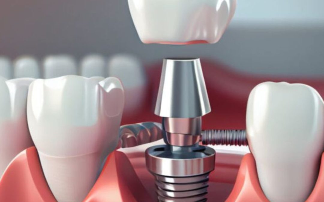 Why Choose a Single-Tooth Implant? Benefits, Procedure, and Recovery