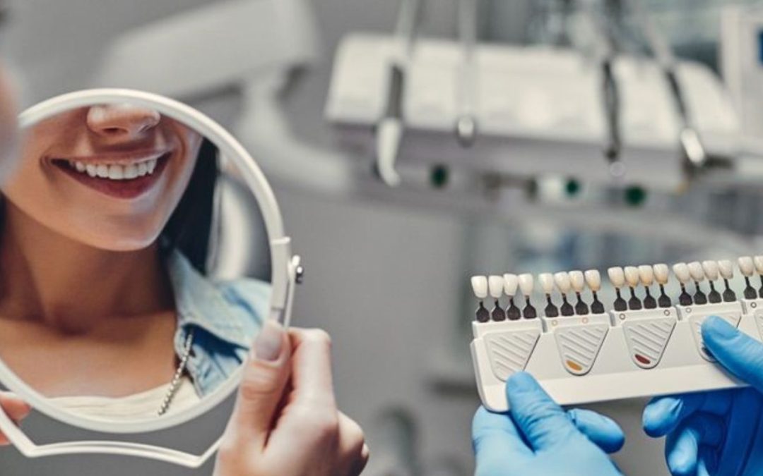 Dental veneers