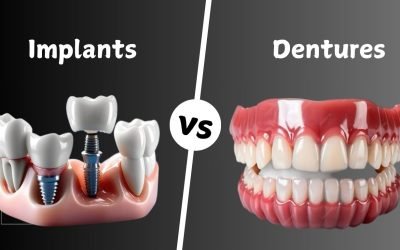 Dental Implants vs. Dentures: Which Tooth Replacement Option is Right for You?