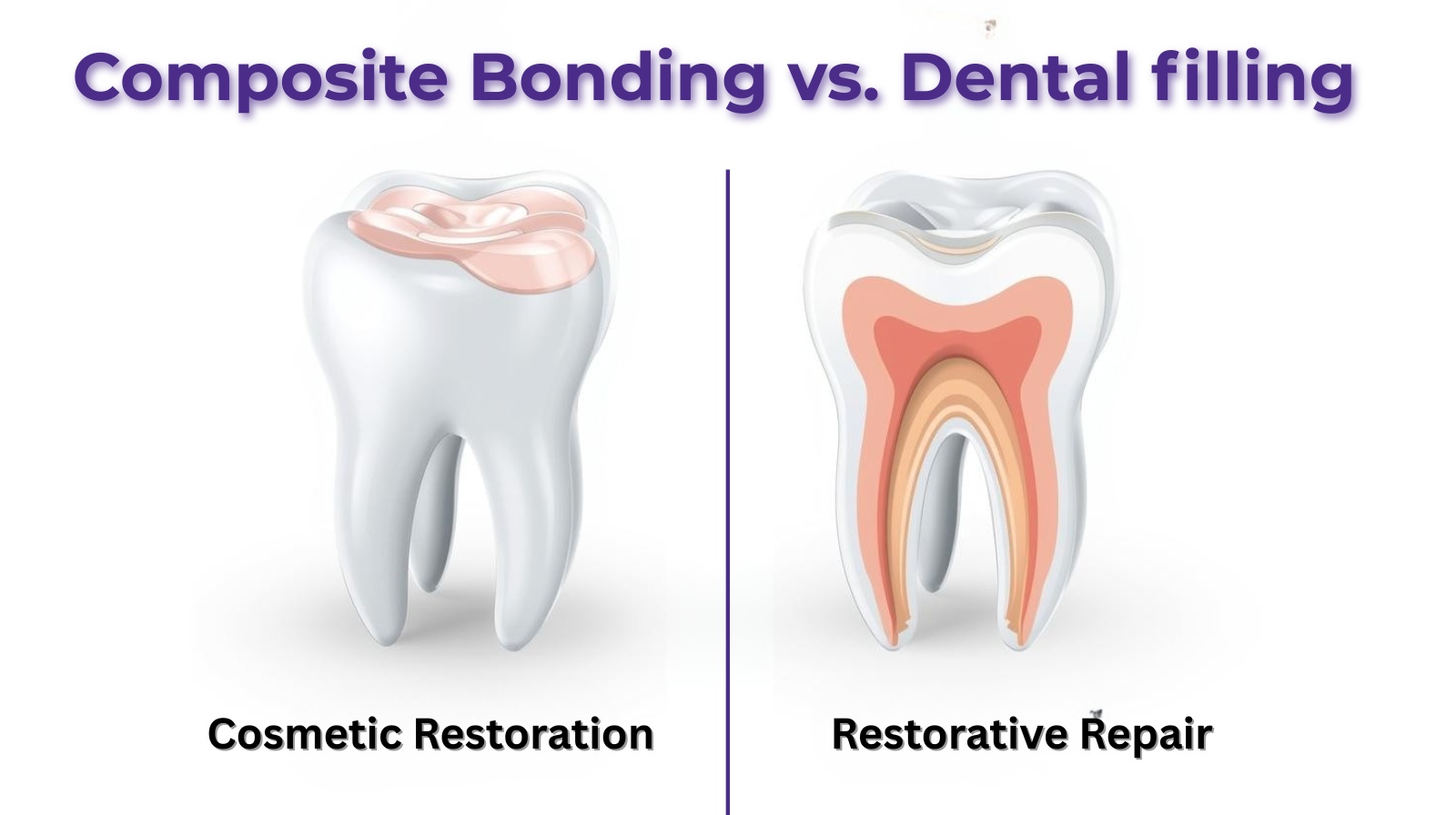 Composite Bonding vs Fillings